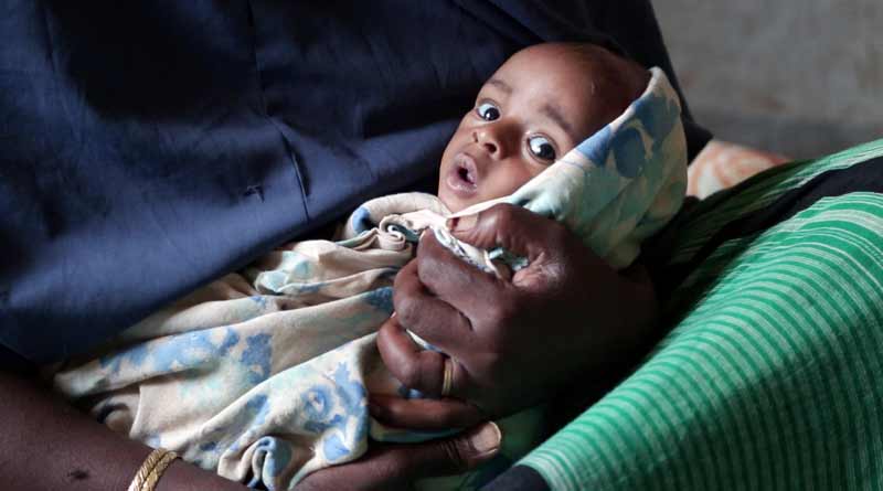 Baby suffers from severe acute malnutrition in Chinaksen